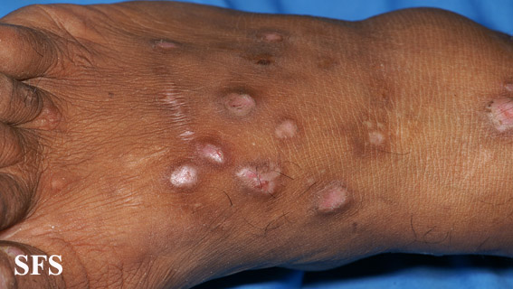 Epidermolysis bullosa pruriginosa. Adapted from Dermatology Atlas.[8]