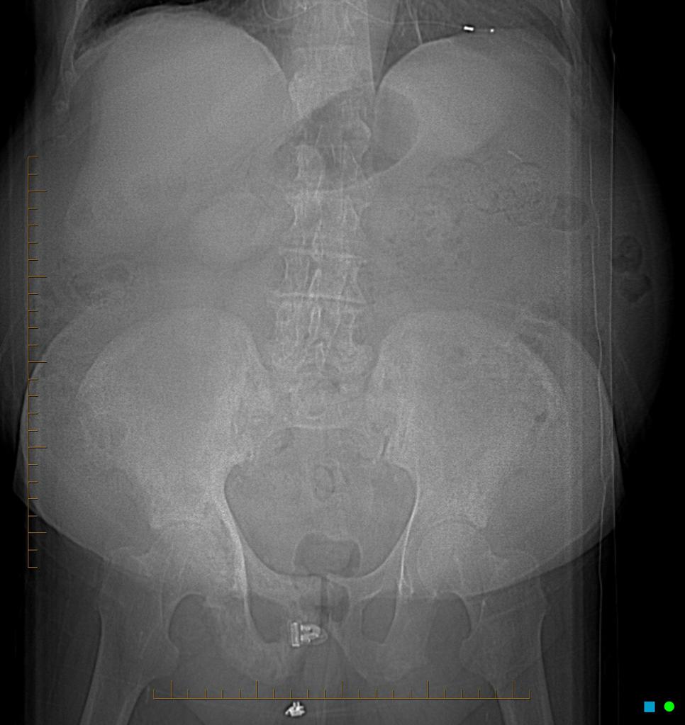 File:Paget-disease-pelvis.jpg