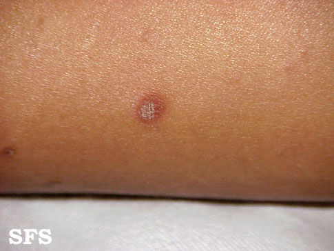 Pityriasis lichenoides chronica. Adapted from Dermatology Atlas.[1]
