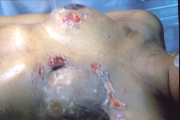 Mastectomy scars with skin metastases