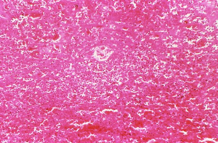 "Hematoxylin-eosin (H&E)-stained photomicrograph of a mediastinal lymph node tissue sample revealed the presence of histopathologic changes indicative of medullary hemorrhage and necrosis in a case of fatal human anthrax.Adapted from Public Health Image Library (PHIL), Centers for Disease Control and Prevention.[21]