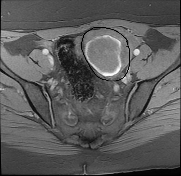MRI showing endometriosis of the urinary bladder.
