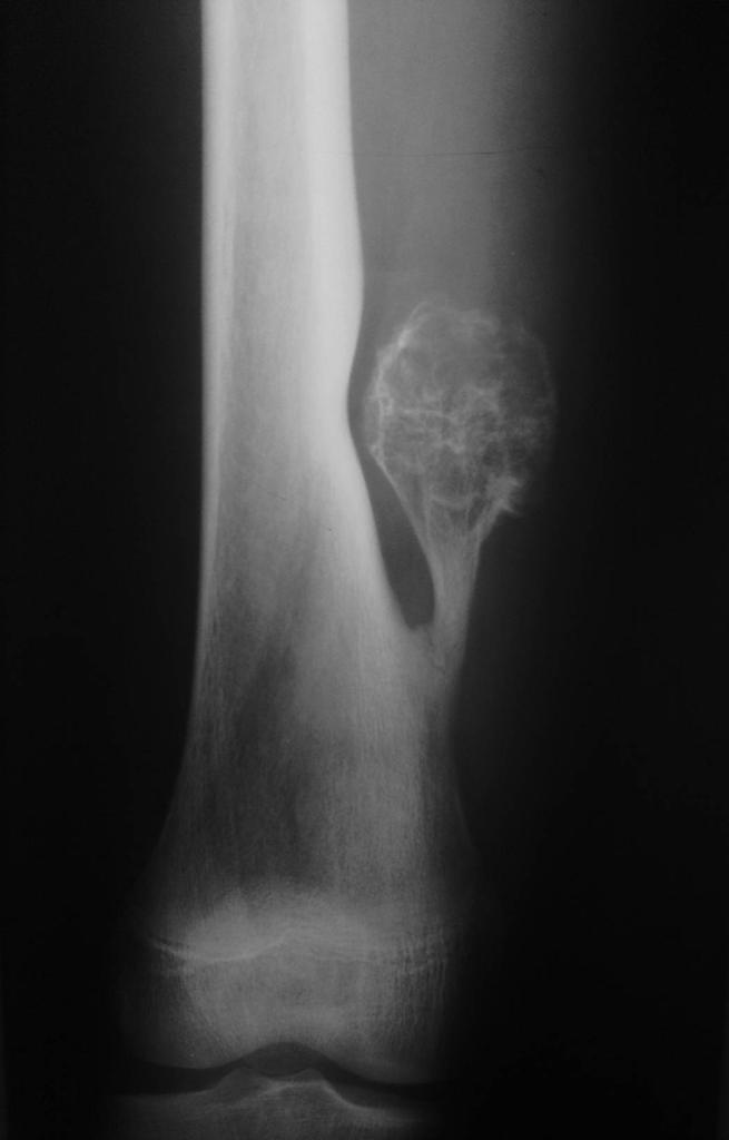 Conventional radiography: Image shows a pedunculated bony growth arising from the metaphyseal projecting away from the epiphysis.