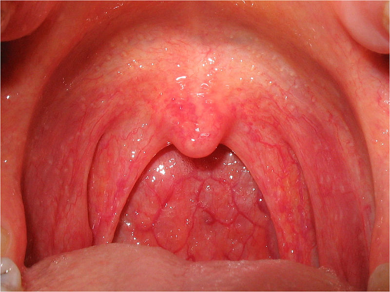 Viral pharyngitis. The oropharynx is swollen and red.