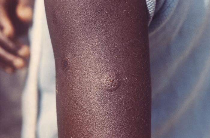 Child’s arm after having received a smallpox vaccination in the country of Sierra Leone. Note intradermal wheal, which is a raised area at the site where the Ped-o-jet® delivered the smallpox vaccine. Adapted from Public Health Image Library (PHIL), Centers for Disease Control and Prevention.[3]