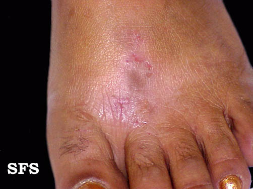 Contact dermatitis. Adapted from Dermatology Atlas.[1]