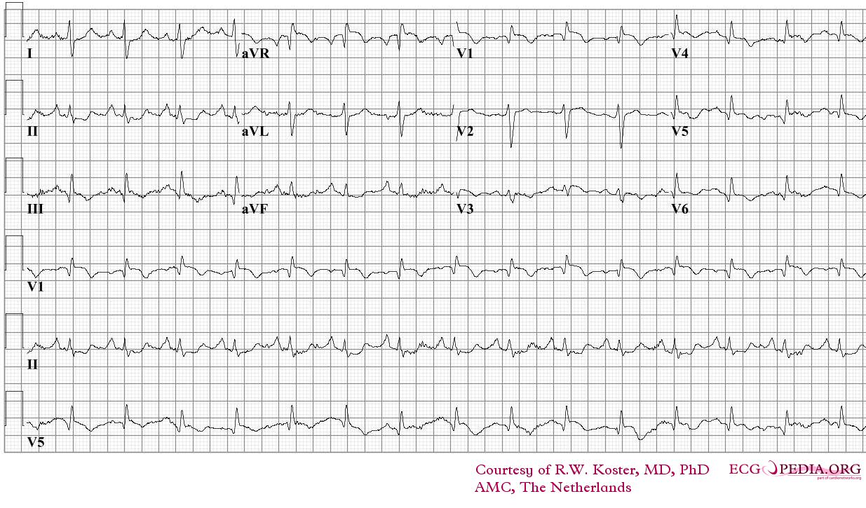 ECG of a patient with pulmonary embolism Image courtesy of ecgpedia