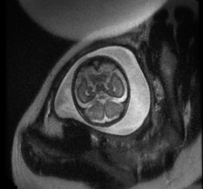 File:Aqueductal stenosis fetal MRI 002.jpg