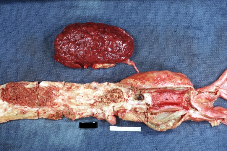 Atherosclerosis: Kidney: Atheromatous Embolus: Gross, natural color, kidney with typical scarring pattern of repeated embolism and aorta with severe atherosclerosis (a quite good example)