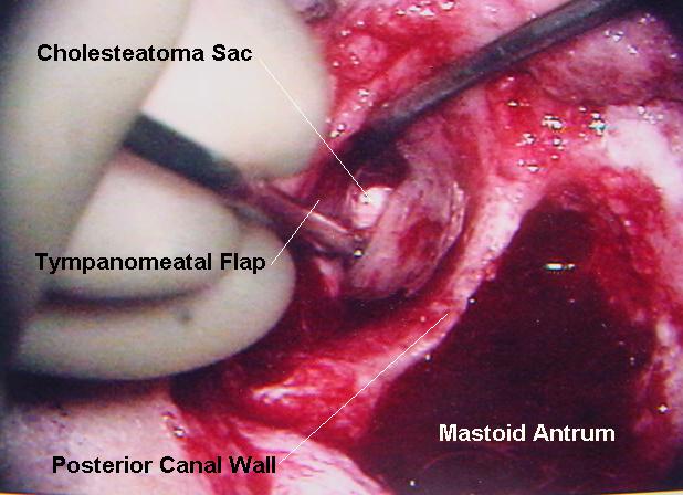 In this left canal wall up mastoidectomy, the tympanic membrane has been elevated forward and a cholesteatoma sac is visible in the attic.[7]
