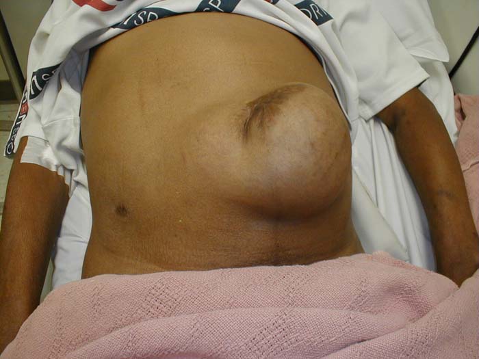 Umbilical Hernia: In this case the increase in size seen in the picture on the right is caused by asking the patient to perform the valsalva maneuver.