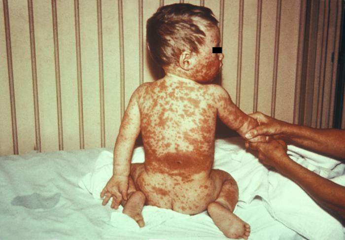 14 month old infant manifested a non-specific rash in the form of extensive erythematous patches over his entire body. From Public Health Image Library (PHIL). [5]