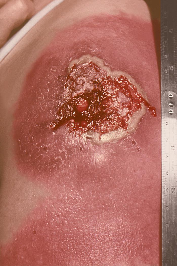 Initial vaccination site. This was a case of progressive vaccinia, also known as vaccinia necrosum, and despite intensive treatment, this patient died, and was found to have a deficiency in her cellular immunity mechanism.Adapted from Public Health Image Library (PHIL), Centers for Disease Control and Prevention.[14]