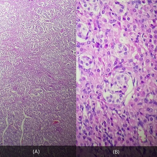 Testes - Atrophy of the seminiferous tubules - Histopathological aspect, HE staining by Regragui Souhail et al from The Pan African Medical Journal - ISSN 1937-8688. Pan Afr Med J. 2016;25:199. Creative Commons Attribution License (http://creativecommons.org/licenses/by/3.0). [17]