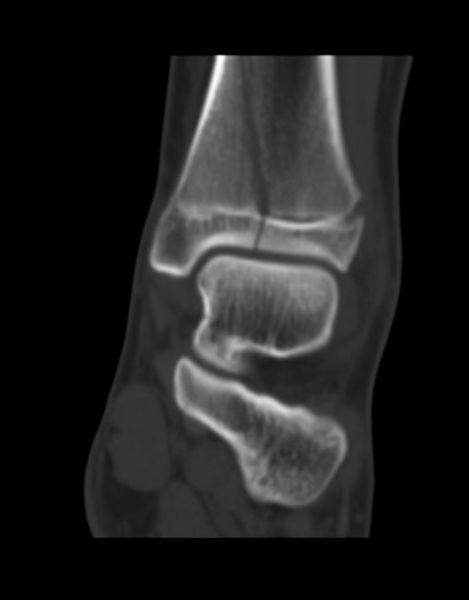 Salter-Harris fracture-IV Image courtesy of RadsWiki and copylefted