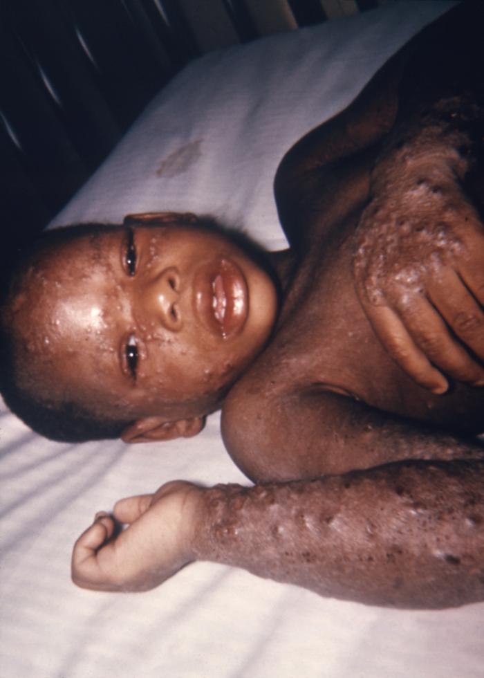 Two year-old African-American boy developed a case of eczema vaccinatum after having received a smallpox vaccination.Adapted from Public Health Image Library (PHIL), Centers for Disease Control and Prevention.[3]