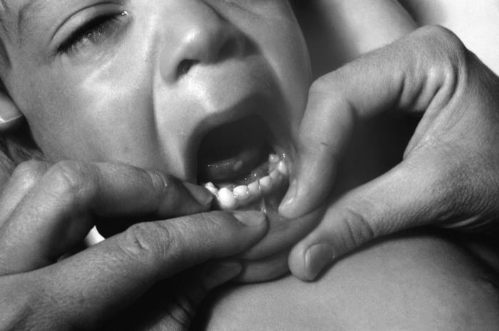 Mouth and oral cavity of a 2 year-old Oregonian child, who after having received a smallpox vaccination, sustained what is termed an “accidental implantation” of the newly-introduced vaccinia virus. Accompanying this phenomenon, the child also developed hand, foot and mouth disease. Note that the tongue displayed a maculopapular lesion attributed to this accidental implantation.Adapted from Public Health Image Library (PHIL), Centers for Disease Control and Prevention.[3]