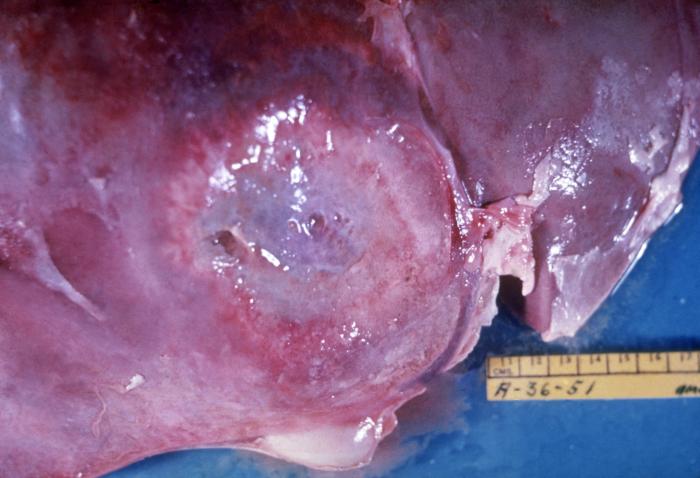 Amebic abscess in liver. Adapted from Public Health Image Library (PHIL). [1]