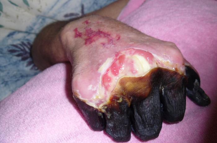 Dorsal view of a 59 year-old man’s right hand who had been infected by the plague bacterium, Yersinia pestis, after having come into contact with both an infected cat, and a dead mouse in his neighborhood. Adapted from Public Health Image Library (PHIL), Centers for Disease Control and Prevention.[2]
