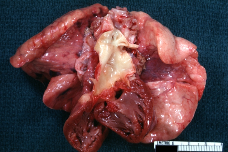 Ventricular Septal Defect: Gross, natural color, view of opened heart with lungs attached shows rather well a subvalvular VSD