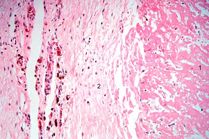 This is a high-power photomicrograph of the border zone between the thrombus (1) and the endocardium (2). In this region there is less inflammation at the border zone.
