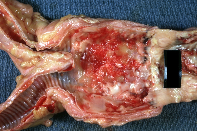 Atherosclerosis: Abdominal Aneurysm Graft Repair: Gross natural color, close-up, an excellent example of Dacron graft that has been in place for years with pseudointima and atherosclerosis