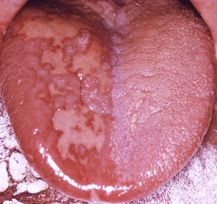 Pathologic changes seen on the surface of the right unilateral side of this elderly male patient’s tongue and chin, represent a herpes outbreak due to the Varicella-zoster virus (VZV) pathogen. From Public Health Image Library (PHIL). [24]