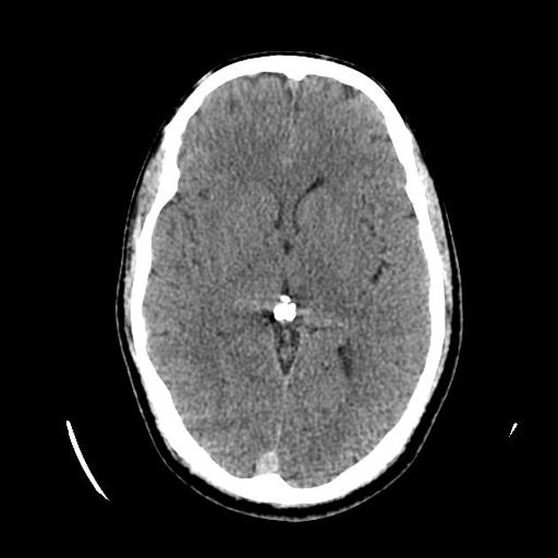 Multiple descrete bilateral supratentorial intraparenchymal cerebral haemorrhage