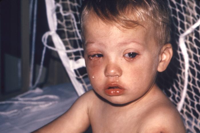 Post-smallpox vaccination complication, this 21 month-old male infant developed secondary facial vaccinial infection involving both eyes and bilateral periorbital areas. Adapted from Public Health Image Library (PHIL), Centers for Disease Control and Prevention.[3]