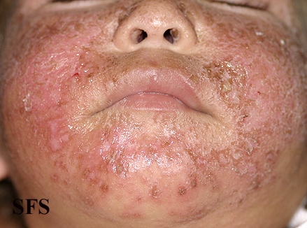 File:Atopic Dermatitis27.jpg