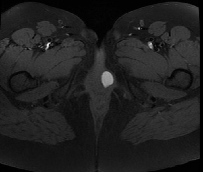 File:Bartholin's gland cyst 004.jpg