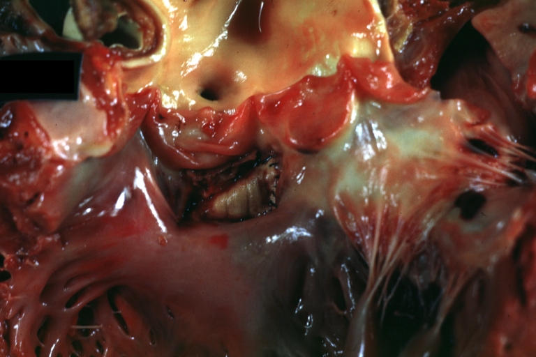 Interventricular Septal Defect Subvalvular with Patch Repair: Gross, natural color, close-up