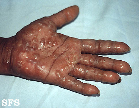 Dyshidrotic eczema. Adapted from Dermatology Atlas.[1]