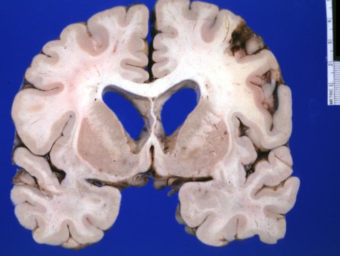 Brain: Microglioma: Gross fixed tissue coronal section cerebral hemispheres with mild ventricular dilation