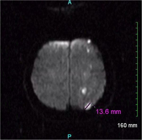 Magnetic resonance imaging of the brain. Diffusion-weighted magnetic resonance image of the brain demonstrating numerous small foci of restricted diffusion scattered within the left frontoparietal cortex, subcortical white matter, and centrum semiovale. These foci are consistent with an acute embolic ischemic infarction shower within the left middle cerebral artery distribution.[3]