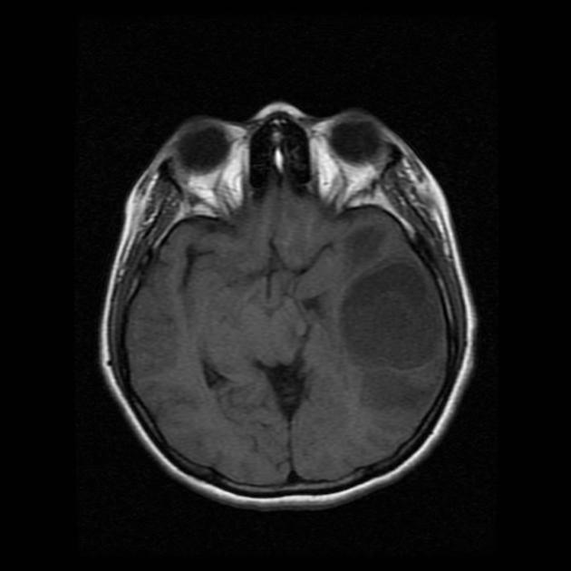 File:MRI of brain abscess.jpg