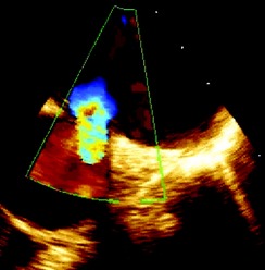 File:Patent ductus arteriosus (PDA) in Transesophageal echocardiography.jpg