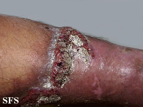 Pyoderma gangrenosum. Adapted from Dermatology Atlas.[5]