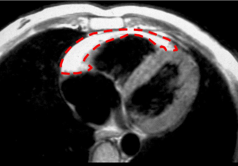 File:ARVD on MRI outlined in red.JPG