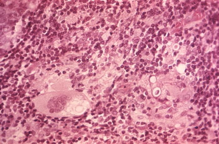 H&E-stained photomicrograph reveals ultrastructural histopathology in an dermal skin tissue specimen in a patient with an intradermal keloidean blastomycosis infection, which was caused by the fungus, Blastomyces dermatitidis.From Public Health Image Library (PHIL). [26]