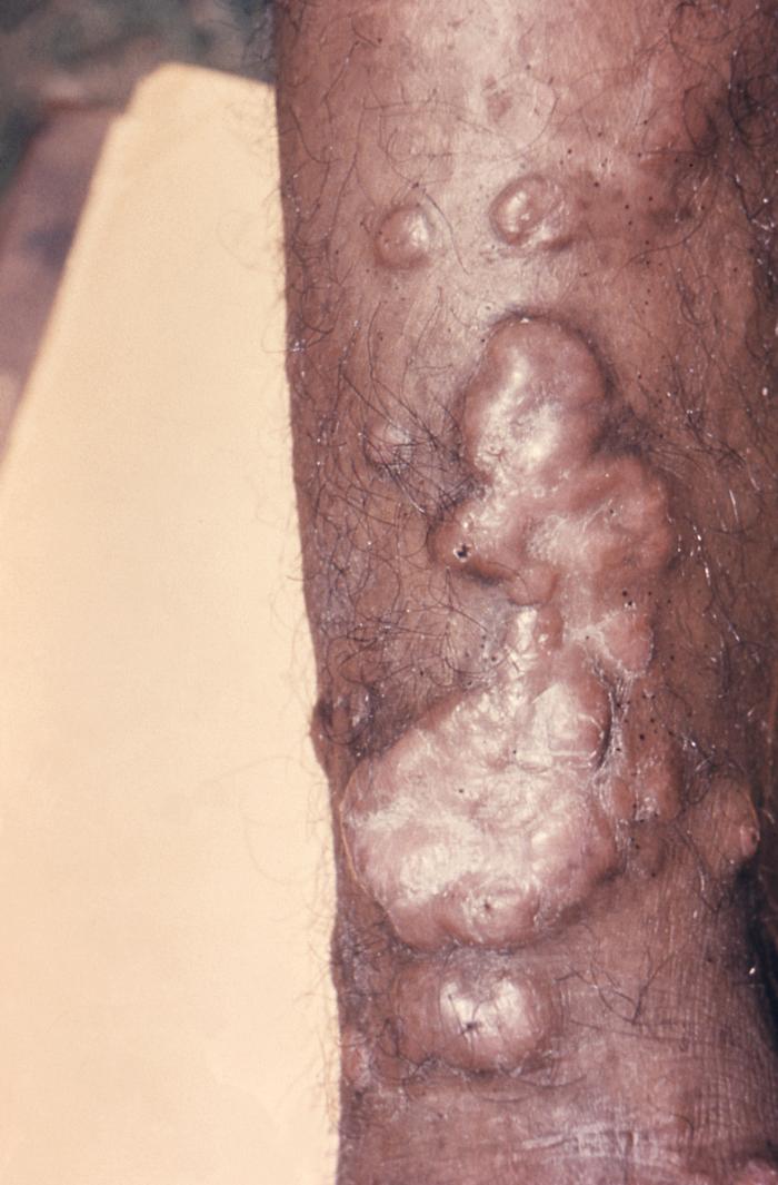 Morphologic changes that took place upon a patient’s arm, which included keloidal scarring brought on due to a case of cutaneous blastomycosis, caused by Blastomyces dermatitidis. From Public Health Image Library (PHIL). [3]