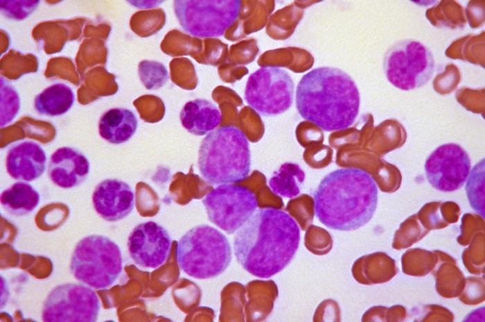 Blast crisis of chronic myelogenous leukemia (CML). Peripheral blood smear revealing the histopathologic features indicative of a blast crisis in the case of chronic myelogenous leukemia.
