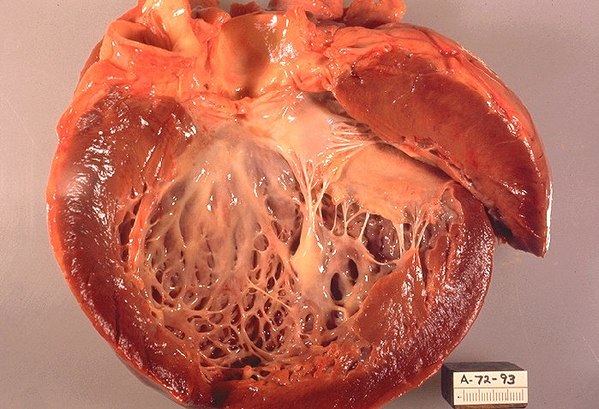 File:Cardiomyopathy.jpg