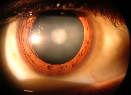 Cataract in Human Eye. Magnified view seen on examination with a slit lamp