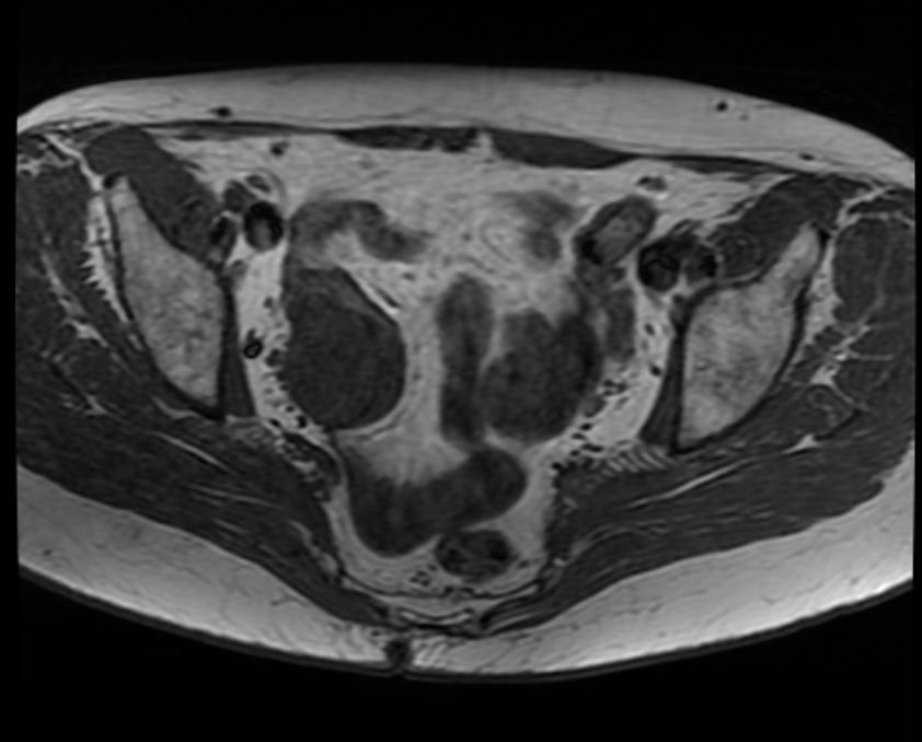 File:Ovarian fibroma MRI 005.jpg
