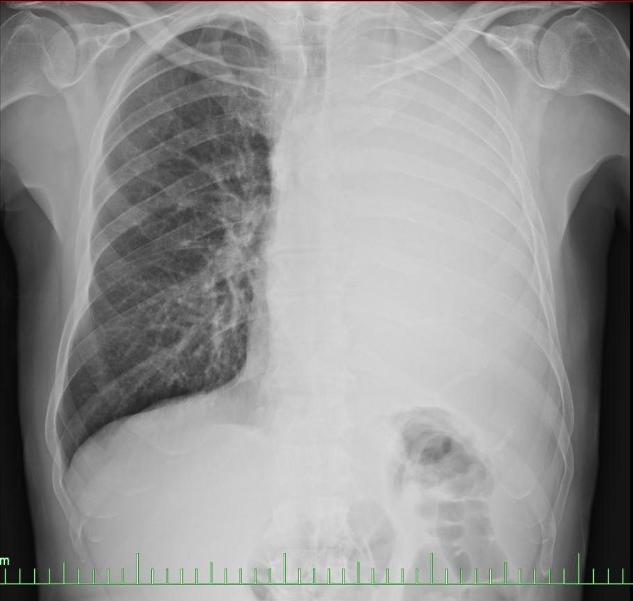 Chest x-ray: Small cell carcinoma of the lung at two months. Courtesy of Cafer Zorkun MD