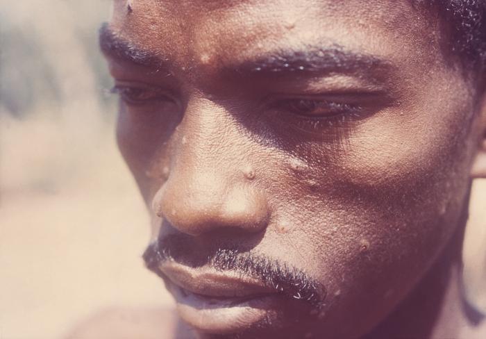 Male from Sierra Leone. Case of “modified” smallpox, in which the patient had received a smallpox vaccination some months before. Note the sparse amount of maculopapular skin lesions dispersed over his face. Adapted from Public Health Image Library (PHIL), Centers for Disease Control and Prevention.[3]