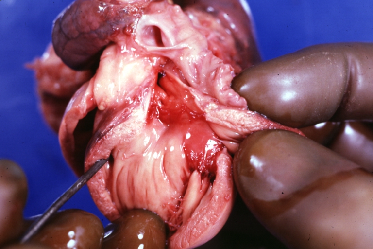 Interventricular Septal Defect (Muscular Septum): Gross, natural color, low septal defect shown from aortic outlet. The same defect (with a probe in hole) shown from right ventricle.