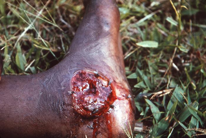 Acute tropical ulcer caused by fusiform bacilli and spirochetes. From Public Health Image Library (PHIL). [10]