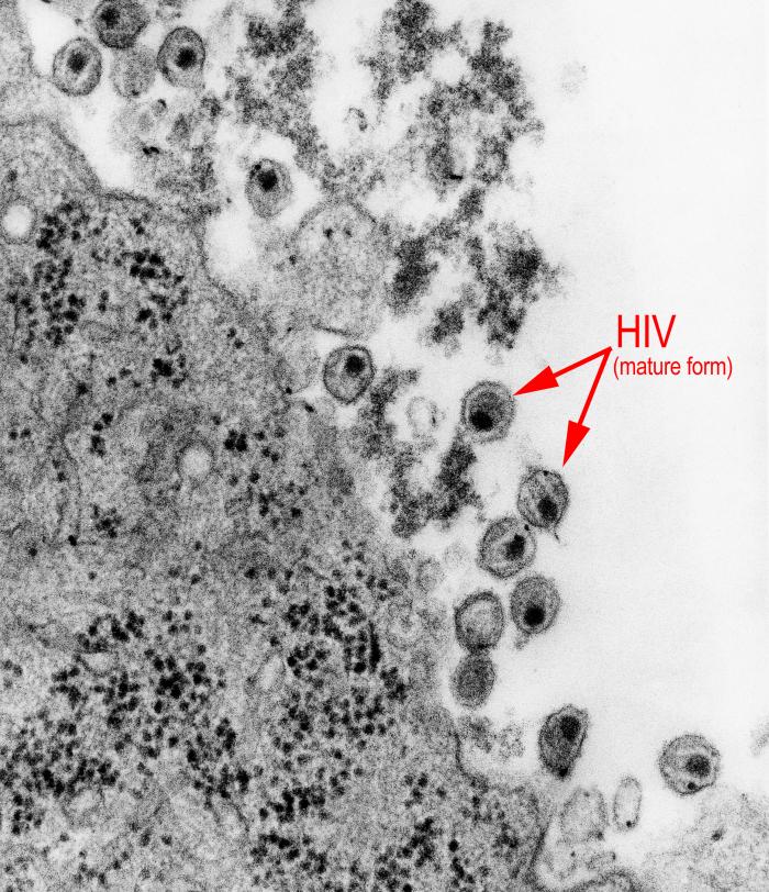 Highly magnified transmission electron micrographic (TEM) image reveals the presence of mature forms of the human immunodeficiency virus (HIV) in a tissue sample. From Public Health Image Library (PHIL). [28]